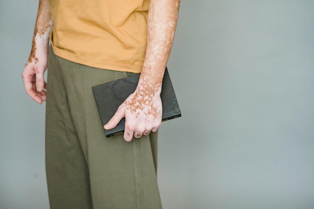 A person holds a book with skin that has vitiligo.