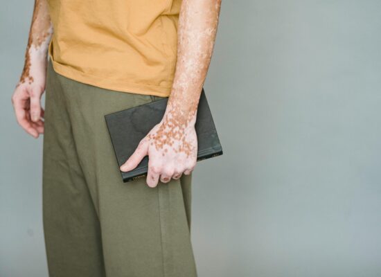 A person holds a book with skin that has vitiligo.