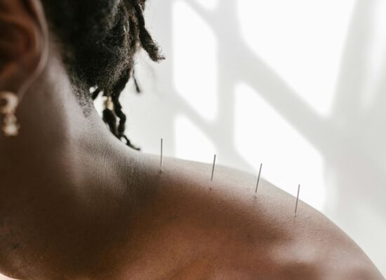 Acupuncture needles inserted into a person's shoulder and upper back.